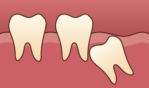 過剰歯・埋伏歯・歯の欠損